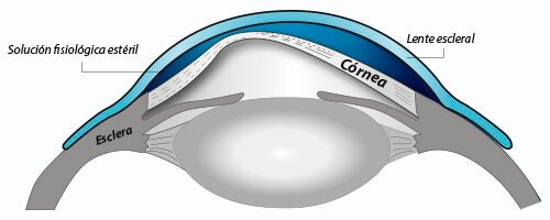 Ayudas Opticas para Queratocono y otras ectasias corneales